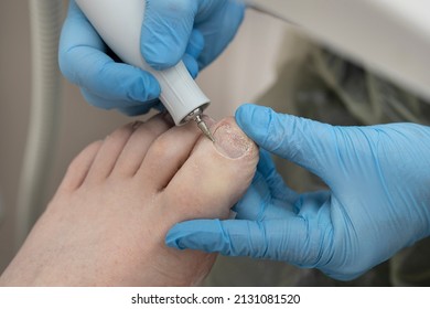 Pedicure podology treatment process of onychomycosis fungal infection of the toenail. filing of the nail plate for the treatment of nail fungus