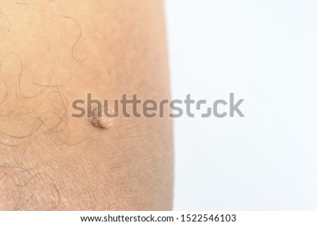 Pedunculated Mass skin tag or acrochondon or soft fibroma. Papilloma bump on male body macro shot on the Thigh