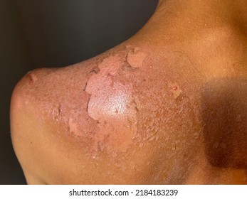 Peel Back And Shoulder Skin From Sunburn Effect On Young Man Body From Sunbathing In Summer