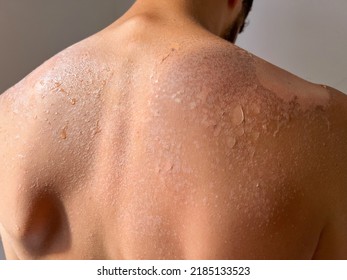 Peel Back And Shoulder Skin From Sunburn Effect On Young Man Body From Sunbathing In Summer