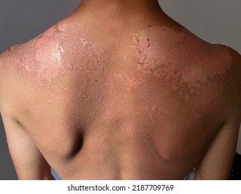 Peel Back And Shoulder Skin From Sunburn Effect On Young Man Body From Sunbathing In Summer