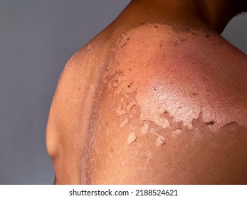 Peel Back And Shoulder Skin From Sunburn Effect On Young Man Body From Sunbathing In Summer