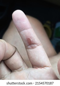 Peeling of finger skin, finger injury