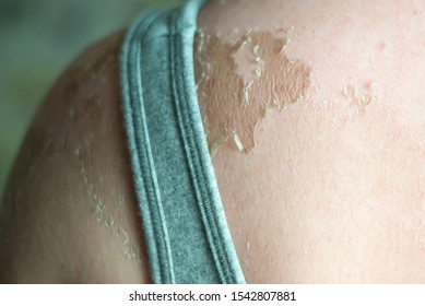 The Peeling Skin From A Bad Tan On The Forearm, The Back Of The Girl Causes Severe Itching. Shallow Depth Of Field