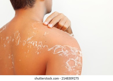 Peeling skin dermatology conditions at man back and shoulder, flaking skin and skincare concept

 - Shutterstock ID 2148309275