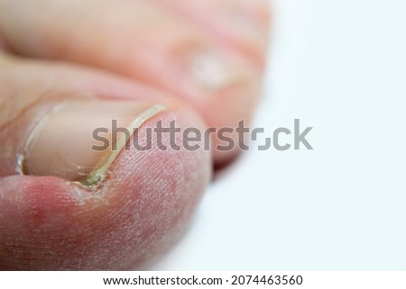 Peeling skin of fingers on a white background, your article about foot care.