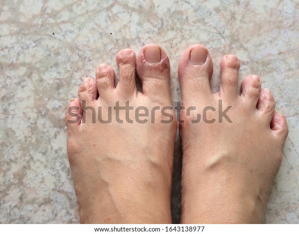 peeling-skin-rash-on-feet-must-stock-photo-1792432474-shutterstock