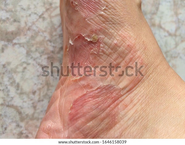 peeling-skin-rash-on-feet-must-stock-photo-1646158039-shutterstock