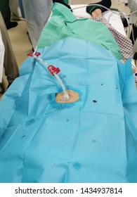 Peg Tube Insertion Or Percutaneous Endoscopic Gastrostomy Tube.