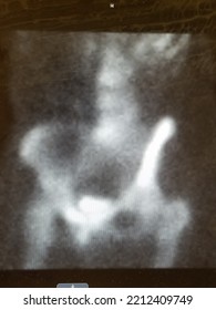 Pelvic Nuclear Medicine Bone Scan - Normal Image