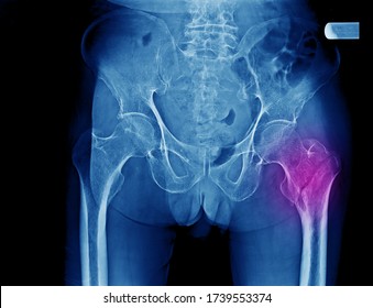 Una radiografía pélvica de un paciente anciano que muestra fractura intertrocantera osteoporótica del fémur. Esta enfermedad necesita tratamiento operativo con reducción cerrada y fijación interna.