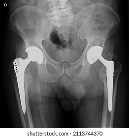 Pelvis Of An Adult With Bilateral Total Hip Replacement. On The Right, A Vascular Stent Is Seen In The Femoral Artery 