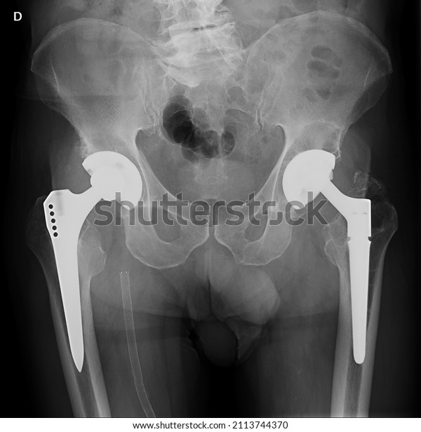 Pelvis of\
an adult with bilateral total hip replacement. On the right, a\
vascular stent is seen in the femoral artery\
