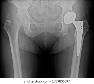 Pelvis anterior posterior view during routine follow up x-ray of a inconspicuous left sided uncemented total hip prosthesis 