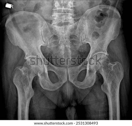 Pelvis AP View X-ray for Hip and Pelvic Bone Evaluation