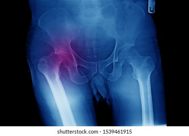 Pelvis And Hip X-ray Showing Posterior Hip Dislocation With Fracture Of Acetabulum After An Accident. The Patient Needs Emergent Closed Reduction Of The Hip And Subsequent Fixation And Reconstruction.