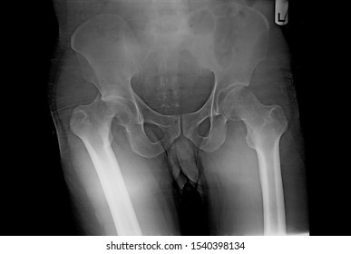 Pelvis And Hip X-ray Showing Posterior Hip Dislocation With Fracture Of Acetabulum After An Accident. The Patient Needs Emergent Closed Reduction Of The Hip And Subsequent Fixation And Reconstruction.