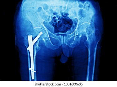 Una pelvis y una radiografía de cadera. El paciente tenía fractura cerrada de fémur proximal derecho en la parte intertrocanétrica. Él sufrió reducción cerrada y fijación interna con uñas. Fractura osteoporótica.