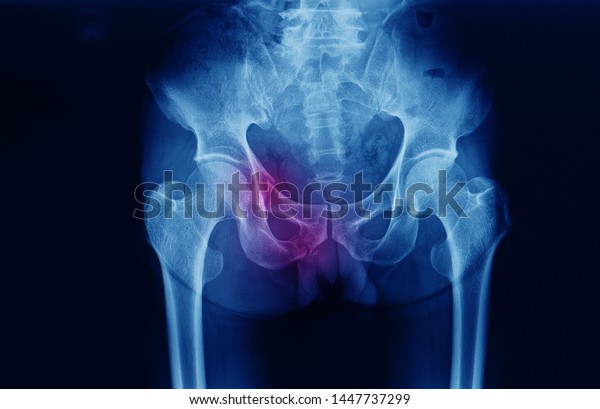Pelvis x-ray of a patient showing superior and\
inferior pubic ramus fracture on the right side after a car\
accident. No acetabulum and hip fracture or dislocation was seen.\
Pelvic fracture.