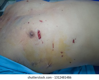 Penetrating Wound Right Chest