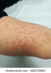 Penicillin Allergy Is An Abnormal Reaction Of Your Immune System To The Antibiotic Drug Penicillin. Common Signs And Symptoms Of Penicillin Allergy Include Hives, Rash And Itching.