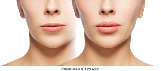 people, cosmetology, plastic surgery and beauty concept - beautiful young woman face woman before and after lips augmentation over white background