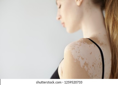 People, Dermatology, Cosmetology And Skin Condition Concept. Side View Of Attractive Young Caucasian Female Wearing Black Bra Showing White Vitiligo Spots. Selective Focus On Woman's Shoulder