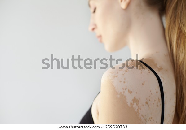 人 皮膚科 化粧品 皮膚病のコンセプト 白い白い斑点を示す黒いブラジャーを着た 魅力的な白人女性の側面 女性の肩に限定フォーカス の写真素材 今すぐ編集