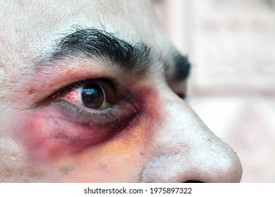 People Infected With Mucormycosis Or Black Fungus  Deadly Disease Affecting Patient  Post  Covid In India,  Closeup Red Blood Conjunctivitis Eyes Of Male, Symptoms, Healthcare And Treatment. 