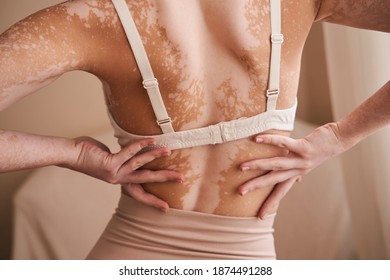 People, lifestyle, health, dermatology and autoimmune disease concept. Rear view of unrecognizable woman with slim body wearing beige underwear, demonstrating white vitiligo spots