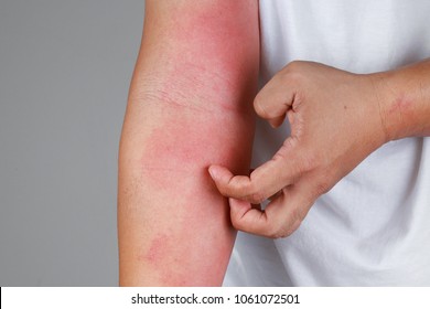 People Scratch The Itch With Hand. Allergic Rash Dermatitis Eczema Skin Of Patient