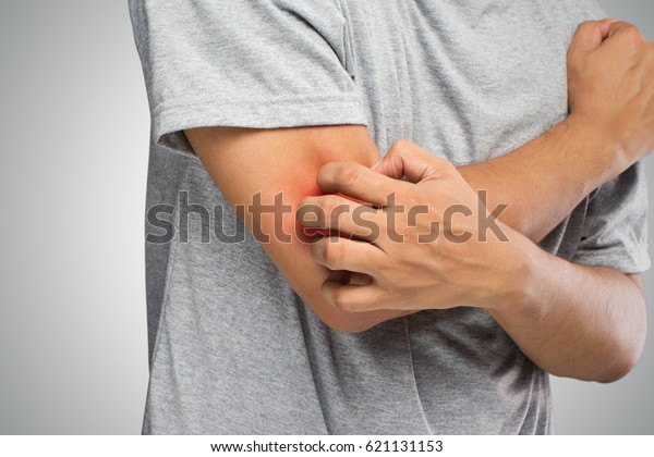 人刮痒用手 肘部 瘙痒 医疗保健 男性皮肤问题概念库存照片 立即编辑