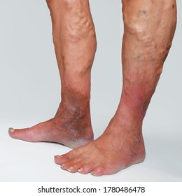 People suffering from varicose veins often come to the phlebologist's office, too late - at the moment when visible signs have already appeared on their legs: swelling, swollen veins, "stars".