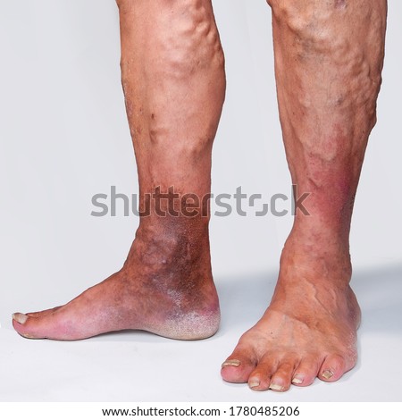People suffering from varicose veins often come to the phlebologists office, too late - at the moment when visible signs have already appeared on their legs: swelling, swollen veins, 