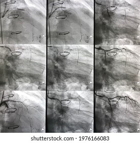 Percutaneous Coronary Intervention At Left Coronary Artery In Patient That Undergoing Open Heart Surgery.