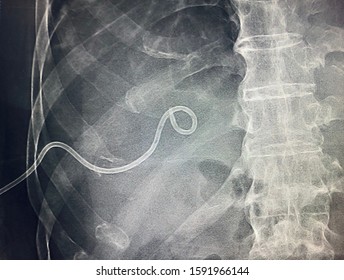 Percutaneous Transhepatic Biliary Drainage (PTBD) At Right Side, A Procedure That Opens A Blocked Bile Duct.