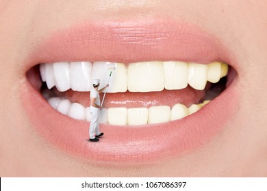 Perfect Smile Before And After Bleaching. Dental Care And Whitening Teeth. Beautiful Teeth. Teeth Whitening By The Dentist.