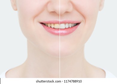 Perfect Smile Before After Bleaching Dental Stock Photo 1174788910