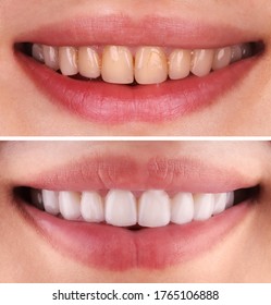 Perfect smile before and after bleaching procedure whitening of young happy smiling woman . Dental restoration treatment clinic patient.Demonstration result of oral care dentistry, stomatology.
