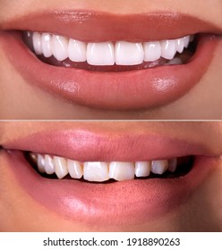 Perfect smile before and after bleaching procedure whitening of zircon arch ceramic prothesis Implants crowns. Dental restoration treatment clinic patient. Result of oral surgery dentistry, - Shutterstock ID 1918890263