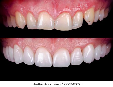 Perfect smile before and after bleaching procedure whitening of zircon arch ceramic prothesis Implants crowns. Dental restoration treatment clinic patient. Result of oral surgery dentistry, - Shutterstock ID 1929159029