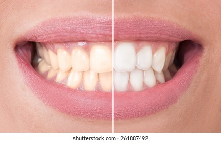 Perfect smile before and after bleaching. Dental care and whitening concept
