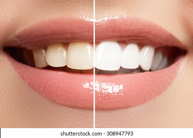 Perfect smile before and after bleaching. Dental care and whitening teeth - Shutterstock ID 308947793