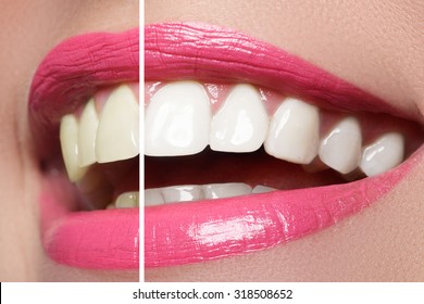 Perfect Smile Before And After Bleaching. Dental Care And Whitening Teeth. Pink Lips.