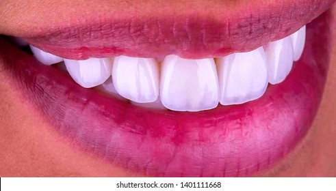 Perfect White Smile With Press Ceramic Veneers