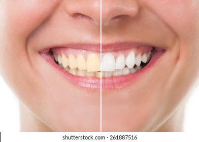 Perfect woman smile before and after whitening. Dental care and periodic exam concept