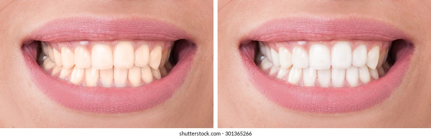 Perfect woman smile before and after bleaching or whitening concept