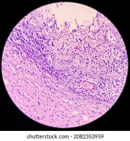 Perianal Region With Fistula Tract, Chronic Granulomatous Inflammation Histologically Consistent With Tuberculosis, Multiple Granulomas With Langhans Giant Cells With Chronic Inflammation Cells.