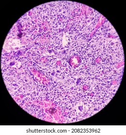 Perianal Region With Fistula Tract, Chronic Granulomatous Inflammation Histologically Consistent With Tuberculosis, Multiple Granulomas With Langhans Giant Cells With Chronic Inflammation Cells.