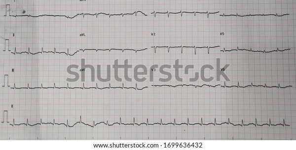 Pericardial Effusion Generalized Low Voltage Normal Stock Photo ...